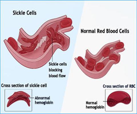 Hydroxyurea Sickle Cell Crisis