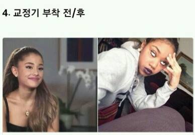 치아교정의 고통 ㄷㄷㄷ.jpg | 인스티즈