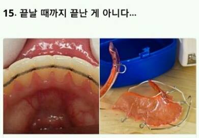치아교정의 고통 ㄷㄷㄷ.jpg | 인스티즈