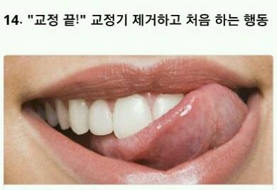 치아교정의 고통 ㄷㄷㄷ.jpg | 인스티즈