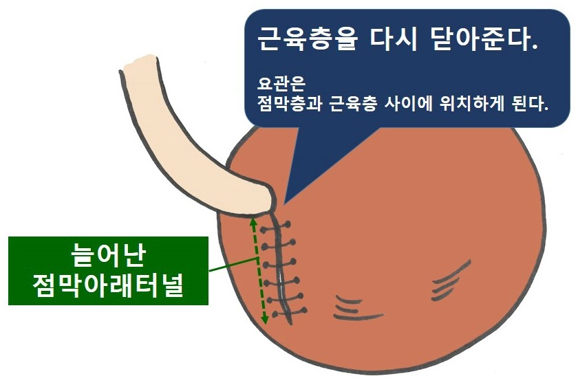 방광요관역류 여러 수술 치료의 원리 비교 : 네이버 블로그 방광요관역류 여러 수술 치료의 원리 비교 : 네이버 블로그