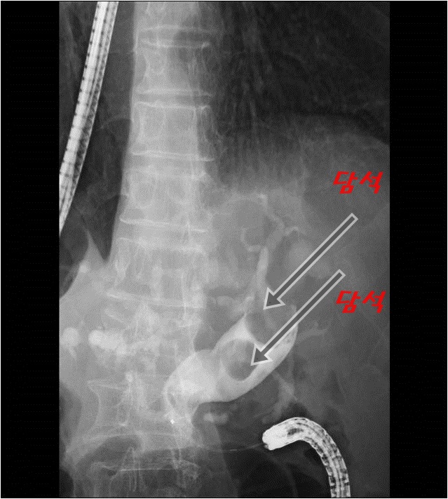 ERCP; 내시경적역행성담췌관조영술, 담석제거, ERBD, ENBD 네이버 블로그