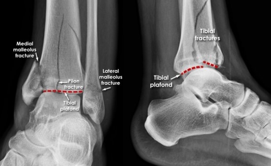 발목 골절 fracture of ankle 발목이 비틀리면서 발목 뼈가 부러졌어요 네이버 블로그 pott s fracture