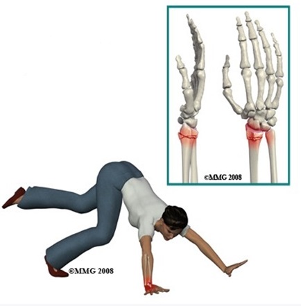 원위 요골 골절(Distal radius fracture) : 중년 여성이 팔을 짚으면서 넘어지면서 손목 ...