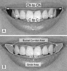 Buccal Corridor