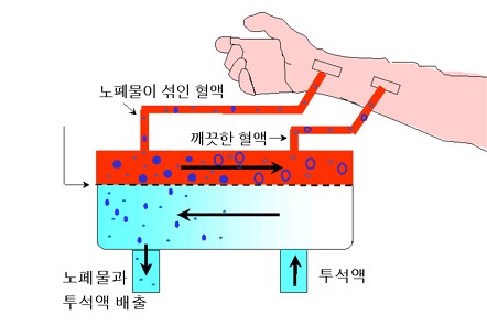 혈액투석의 원리 - 1st : 네이버 블로그